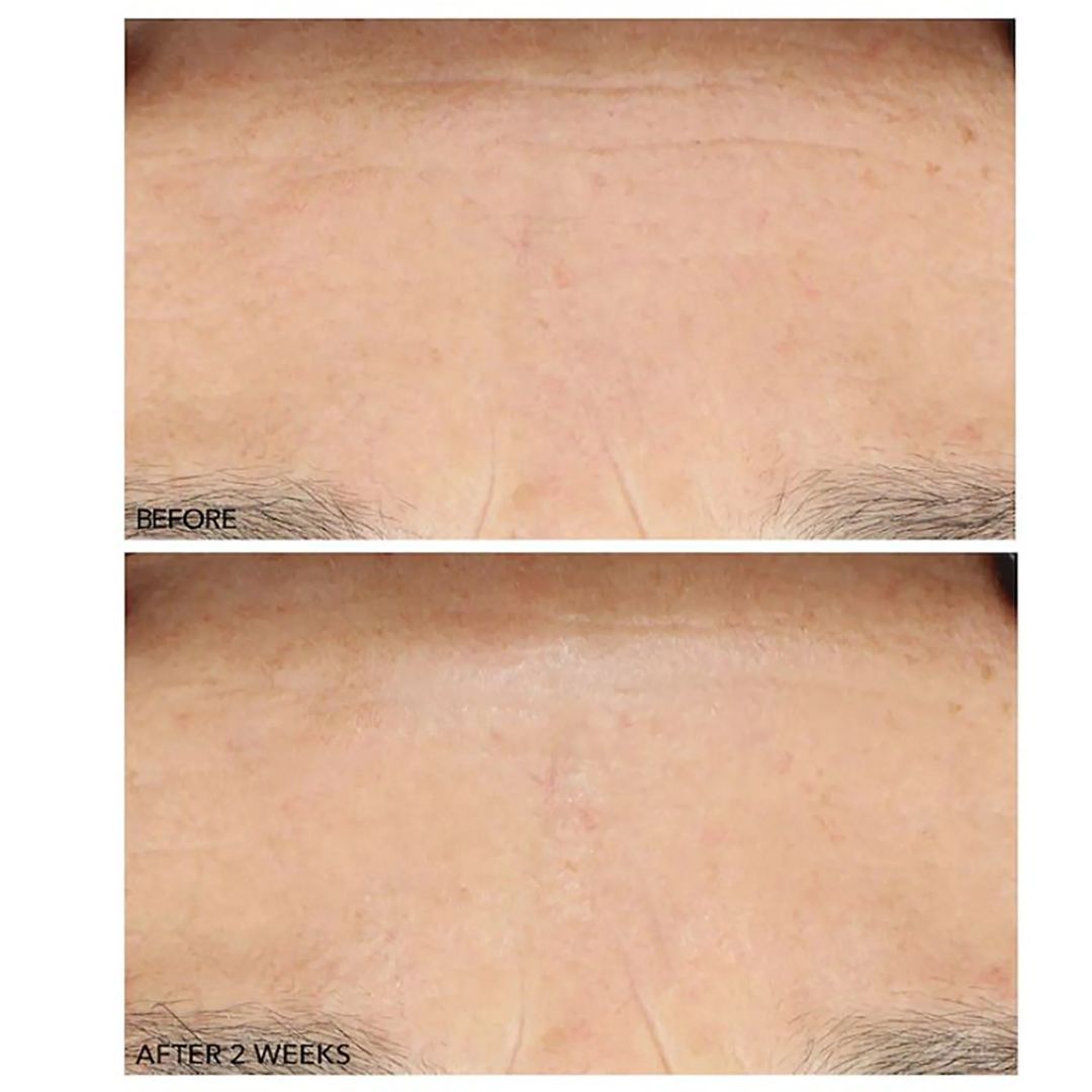Dr. Dennis Gross - Clinical Grade Resurfacing Liquid Peel - 2 x 1 Oz