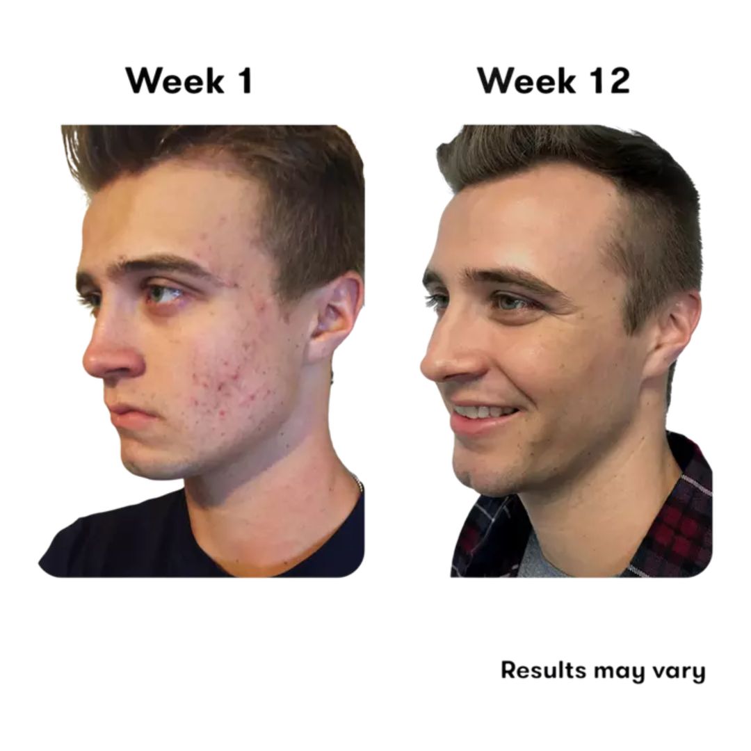 Proactiv - Solution-3 Step Acne Treatment System - 2 Oz/ 2 Oz / 1 Oz