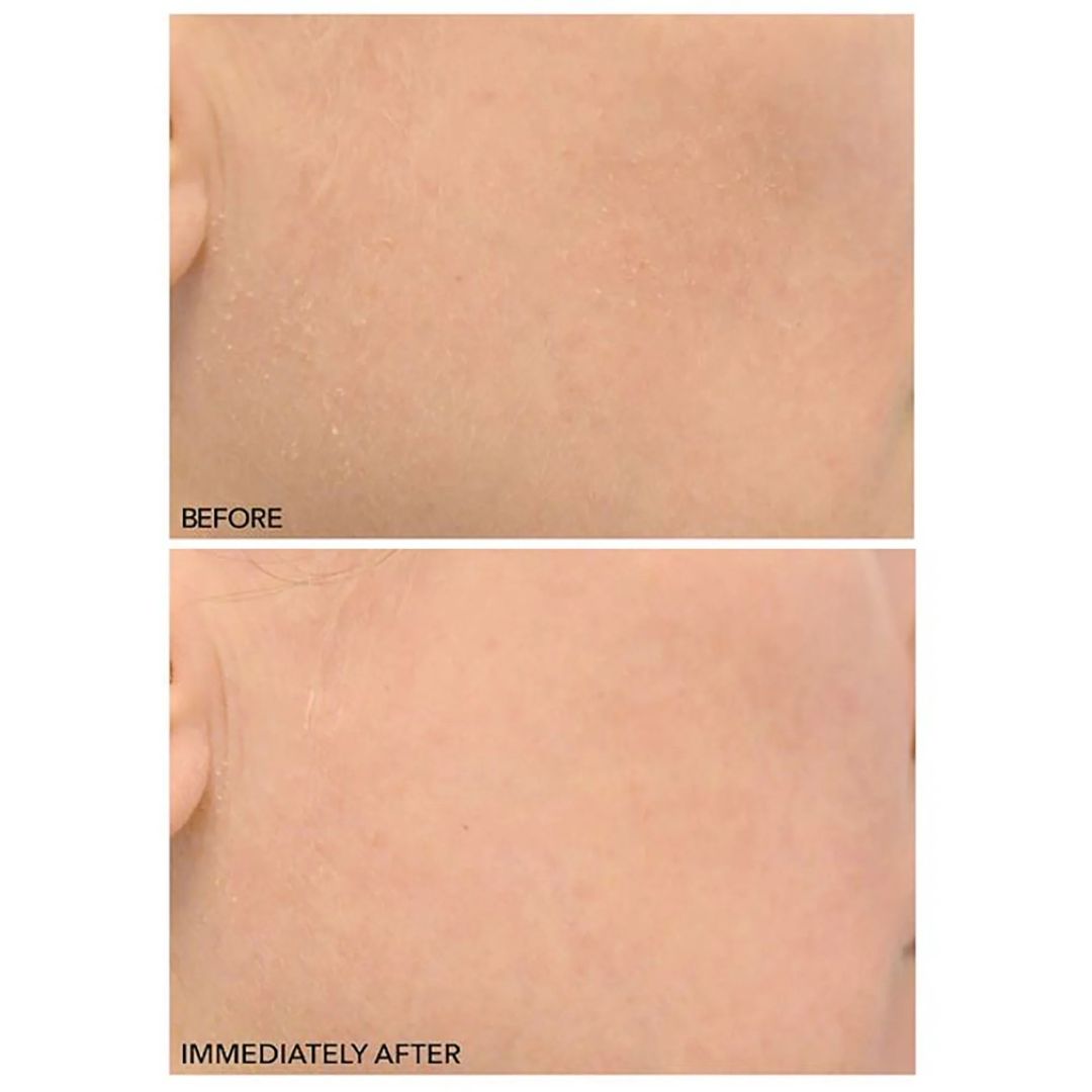 Dr. Dennis Gross - Clinical Grade Resurfacing Liquid Peel - 2 x 1 Oz