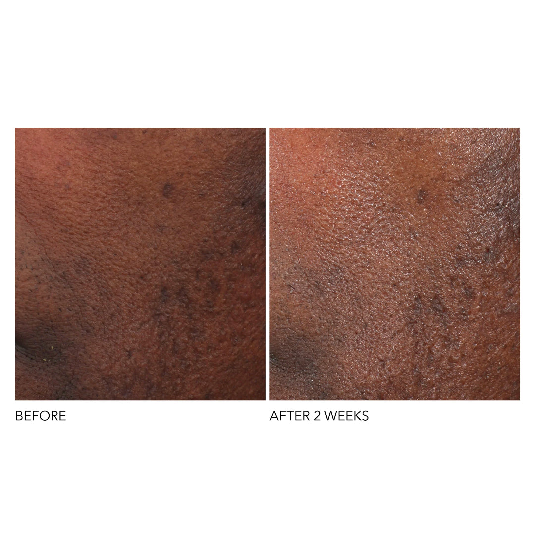 Dr. Dennis Gross - Advanced Retinol + Ferulic Overnight Wrinkle Treatment - 1 Oz Set of 2