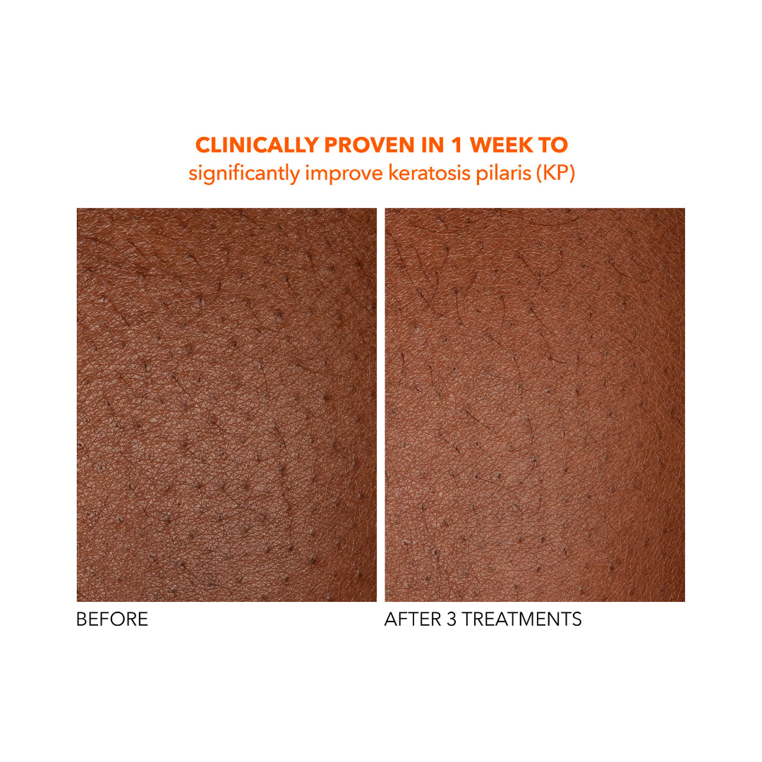 Dr. Dennis Gross - Alpha Beta Exfoliating Body Treatment - 8 Treatments Set of 2