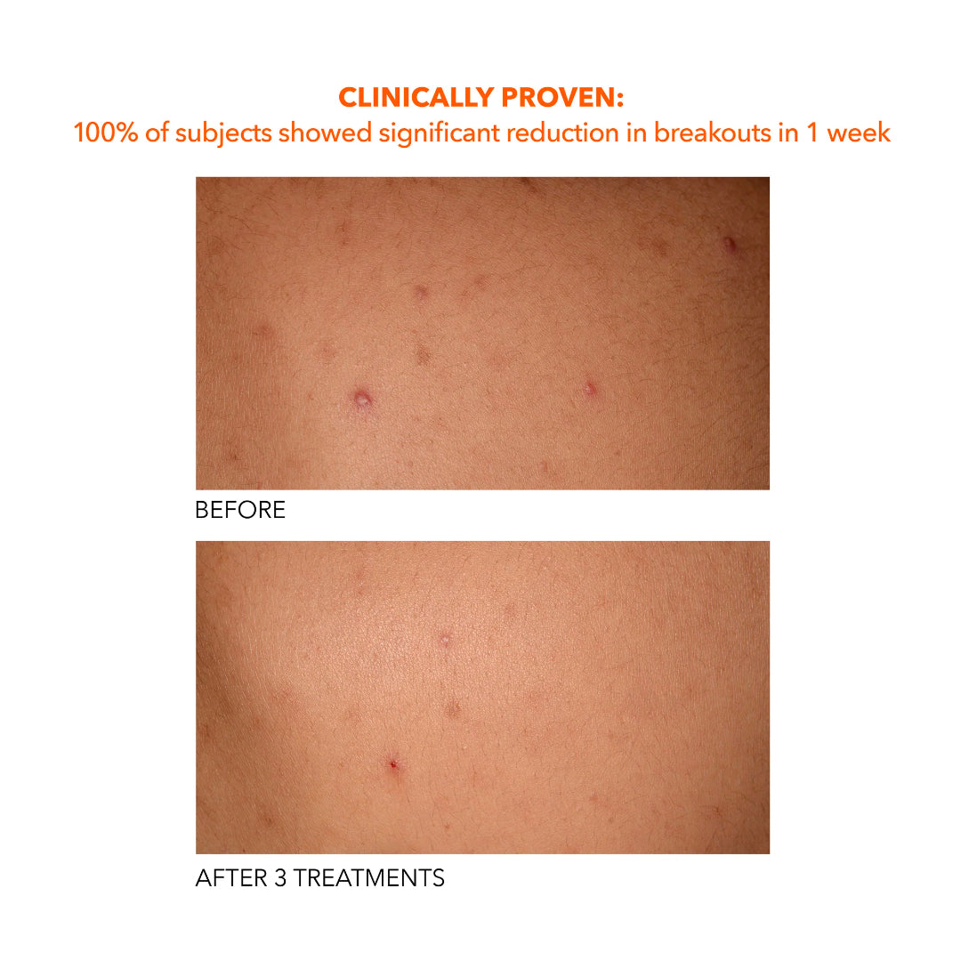 Dr. Dennis Gross - Alpha Beta Exfoliating Body Treatment - 8 Treatments Set of 2