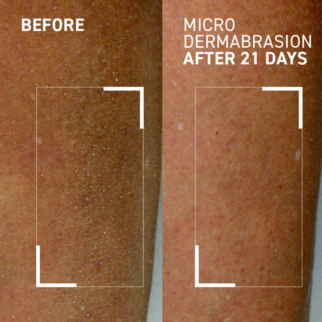 Dr. Brandt - Microdermabrasion Body Exfoliator - 5.3 Oz